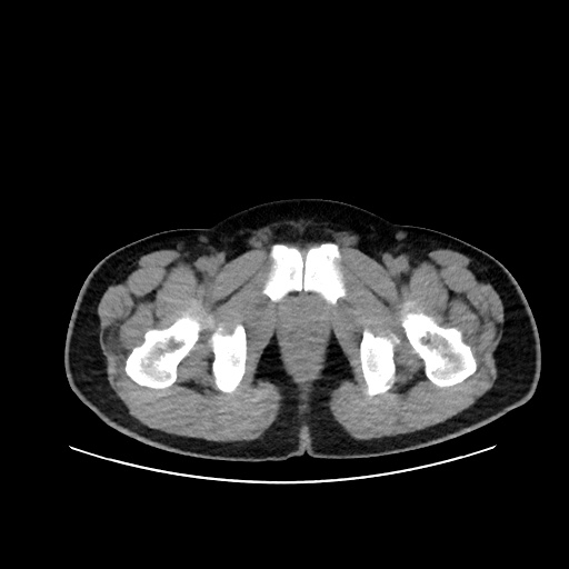 Acute appendicitis and COVID 19 pneumonia (Radiopaedia 76604-88380 Axial non-contrast 123).jpg