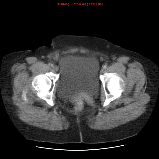 Acute appendicitis complicated by ovarian vein thrombophlebitis (Radiopaedia 16172-15851 Axial C+ portal venous phase 82).jpg