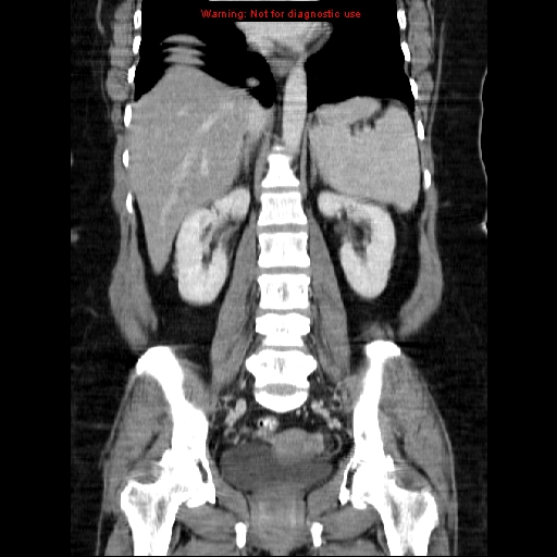 Acute appendicitis complicated by ovarian vein thrombophlebitis (Radiopaedia 16172-15851 Coronal C+ portal venous phase 52).jpg