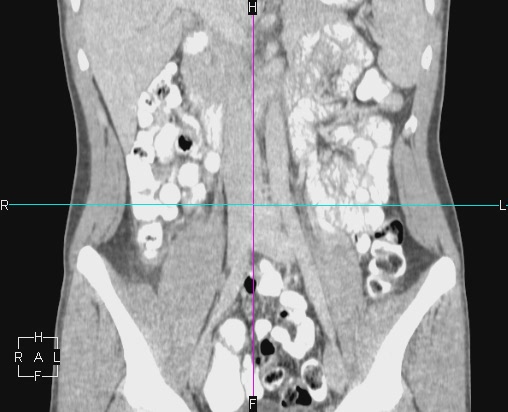 File:Acute appendicitis with CT arrowhead sign (Radiopaedia 21474-21411 Coronal C+ portal venous phase 12).JPG