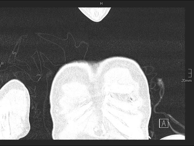 File:Acute aspiration pneumonitis (Radiopaedia 55642-62166 Coronal lung window 2).jpg