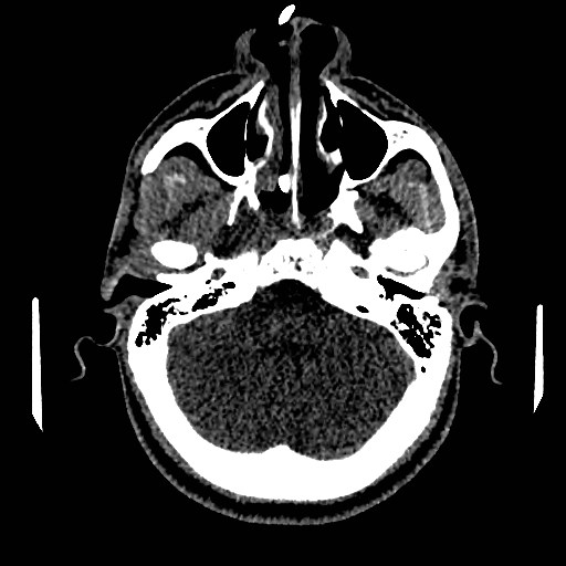 File:Acute basilar artery occlusion (Radiopaedia 43582-46985 Axial non-contrast 49).jpg