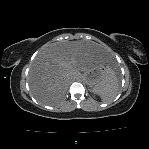 Acute bilateral pyelonephritis (Radiopaedia 37146-38881 Axial non-contrast 21).jpg