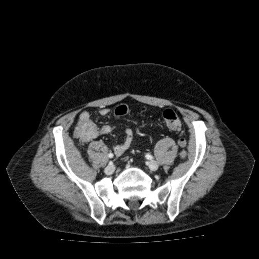 Acute cholecystitis and incidental left sided IVC (Radiopaedia 49352-54459 Axial C+ portal venous phase 115).jpg