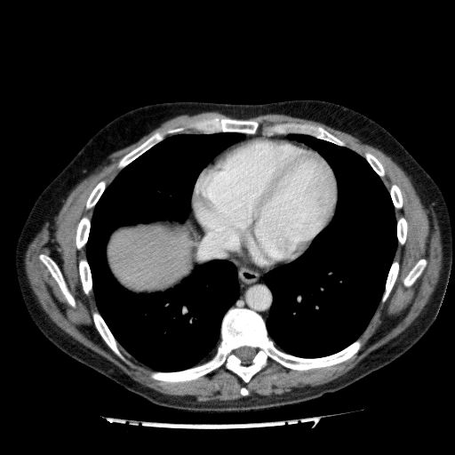 File:Acute cholecystitis and incidental left sided IVC (Radiopaedia 49352-54459 Axial C+ portal venous phase 18).jpg