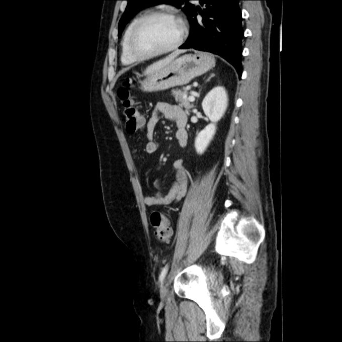 Acute cholecystitis and incidental left sided IVC (Radiopaedia 49352-54459 Sagittal C+ portal venous phase 34).jpg