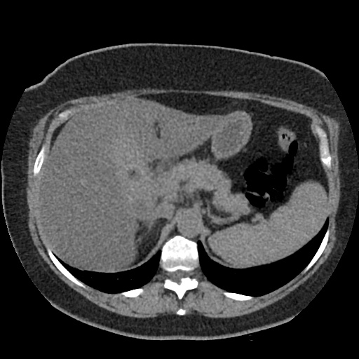 Acute cholecystitis and ureteric colic (Radiopaedia 42330-45444 Axial prone 18).jpg