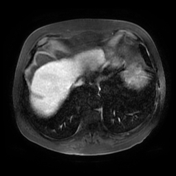 File:Acute cholecystitis complicated by pylephlebitis (Radiopaedia 65782-74915 Axial arterioportal phase T1 C+ fat sat 7).jpg