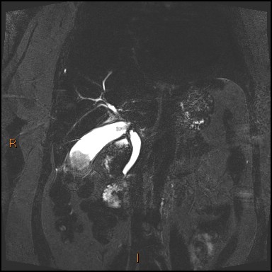 File:Acute cholecystitis with gallbladder neck calculus (Radiopaedia 42795-45971 Coronal Turbo spin echo 20).jpg