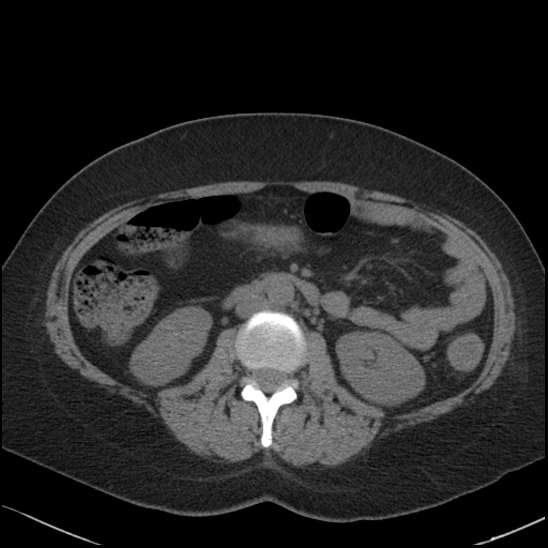 Acute colonic hemorrhage in ulcerative colitis (Radiopaedia 77415-89538 Axial non-contrast 62).jpg