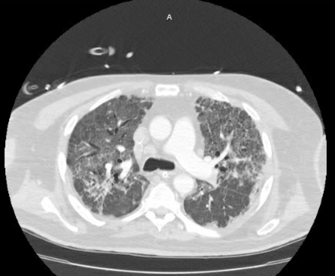 Acute cor pulmonale (ultrasound) (Radiopaedia 83508-98818 Axial lung window 35).jpg