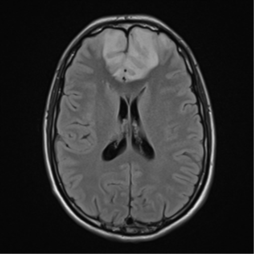 File:Acute disseminated encephalomyelitis (ADEM) (Radiopaedia 65319-74349 Axial FLAIR 19).png