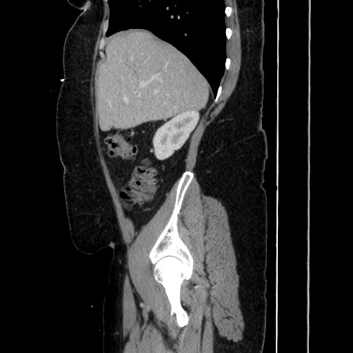 Acute diverticulitis - transverse colon (Radiopaedia 87063-103327 Sagittal C+ portal venous phase 79).jpg