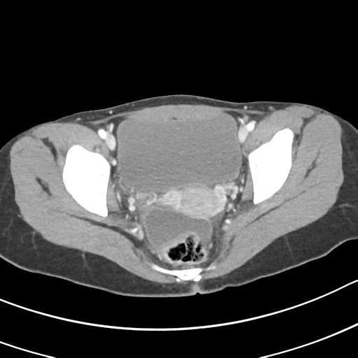 Acute gangrenous appendicitis with perforation (Radiopaedia 40152-42662 Axial C+ portal venous phase 67).png