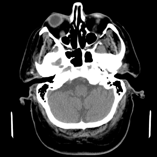 File:Acute hemorrhagic stroke (Radiopaedia 17507-17223 Axial non-contrast 11).jpg
