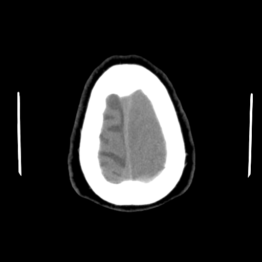 Acute hemorrhagic stroke (Radiopaedia 17507-17223 Axial non-contrast 47).jpg