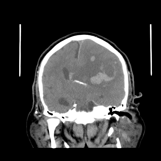 File:Acute hemorrhagic stroke (Radiopaedia 17507-17223 Coronal non-contrast 27).jpg