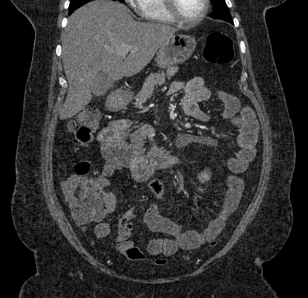 Acute mesenteric ischemia (Radiopaedia 80029-93316 Coronal C+ arterial phase 45).jpg