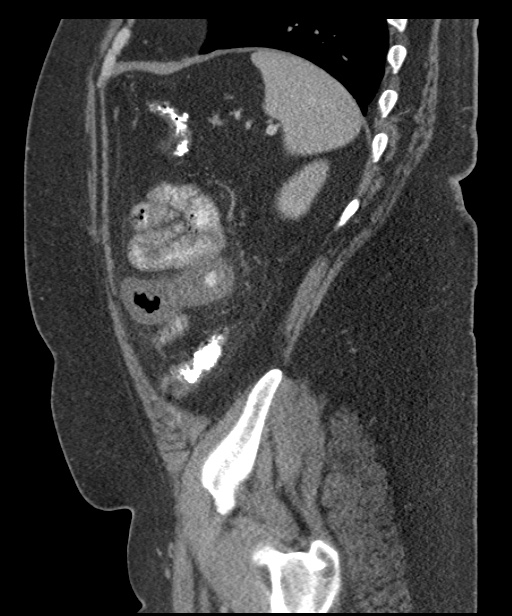 Acute mesenteric venous ischemia (Radiopaedia 46041-50383 Sagittal C+ portal venous phase 94).jpg