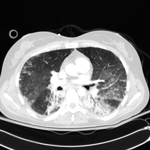 Acute myocardial infarction in CT (Radiopaedia 39947-42415 Axial lung window 61).jpg