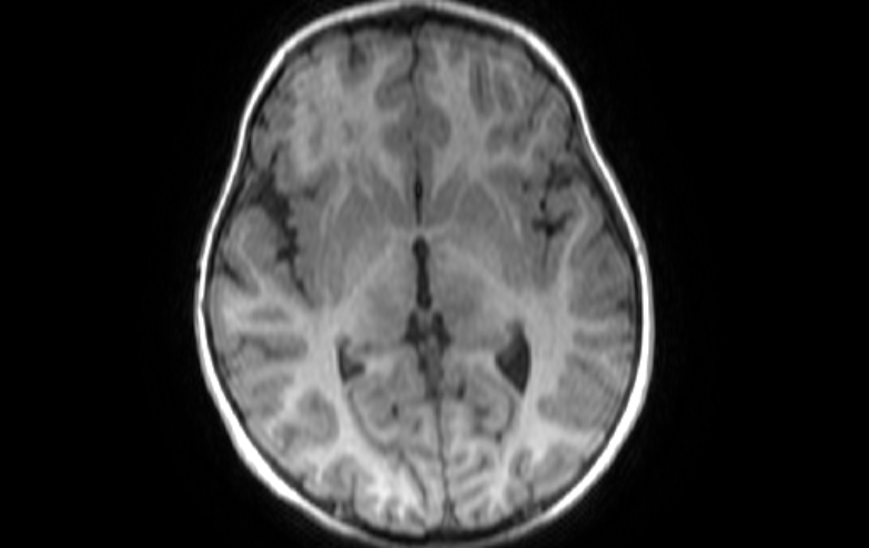File:Acute necrotizing encephalitis of childhood (Radiopaedia 67356-76737 Axial T1 49).jpg