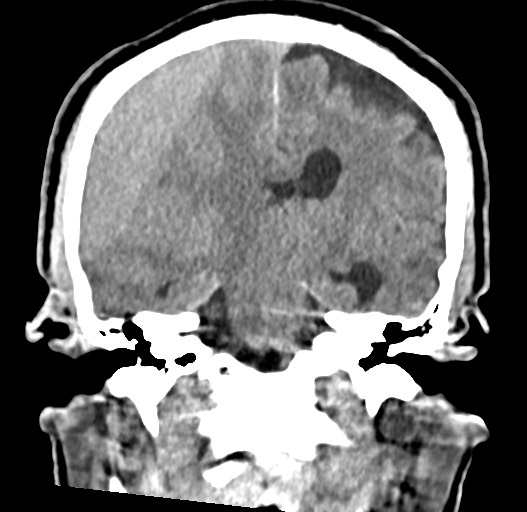Acute on chronic subdural hematoma (Radiopaedia 78346-90966 Coronal non-contrast 38).jpg