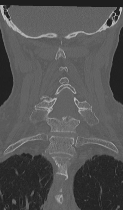 Acute on chronic subdural hematoma and thoracic vertebral injury in a multitrauma patient (Radiopaedia 31698-32619 Coronal bone window 37).jpg