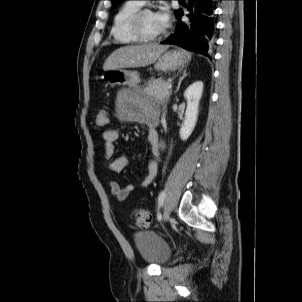 Acute pancreatitis (Radiopaedia 26663-26813 Sagittal C+ portal venous phase 48).jpg