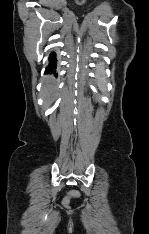 Acute pancreatitis (Radiopaedia 80007-93285 Coronal C+ portal venous phase 134).jpg