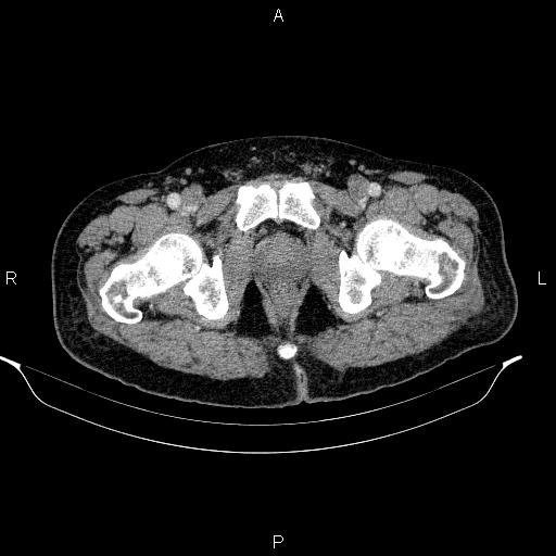 Acute pancreatitis (Radiopaedia 85390-101010 Axial C+ portal venous phase 110).jpg