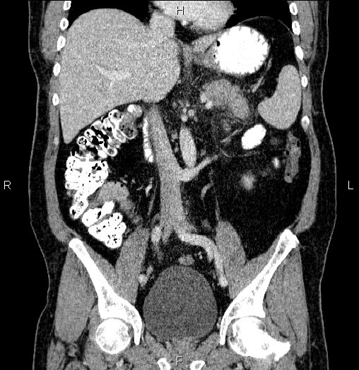 File:Acute pancreatitis (Radiopaedia 85390-101010 Coronal C+ portal venous phase 37).jpg