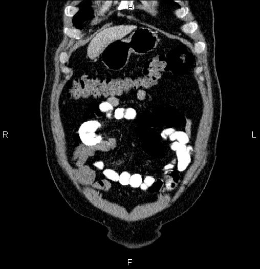 Acute pancreatitis (Radiopaedia 85390-101010 Coronal C+ portal venous phase 7).jpg