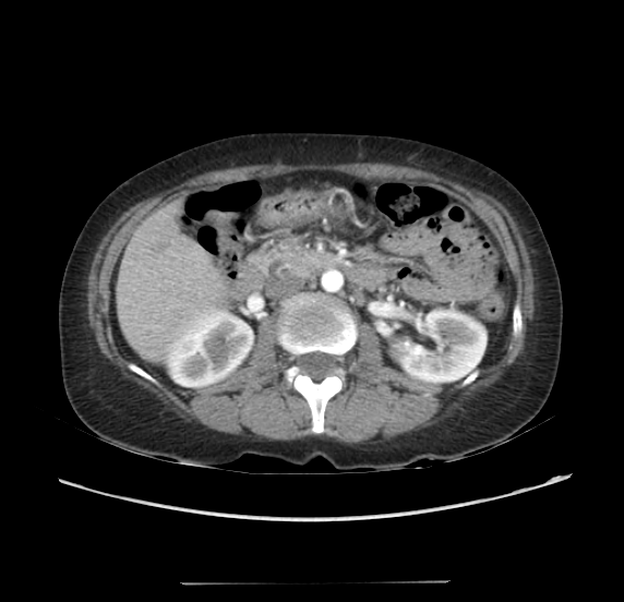 File:Acute pancreatitis - Balthazar E - post ERCP (Radiopaedia 27562-27772 Axial C+ arterial phase 24).png
