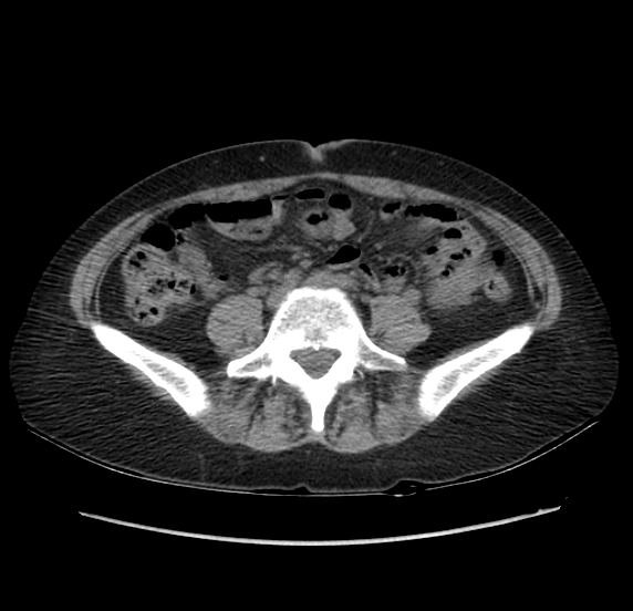 File:Acute pancreatitis - Balthazar E - post ERCP (Radiopaedia 27562-27772 Axial non-contrast 41).png