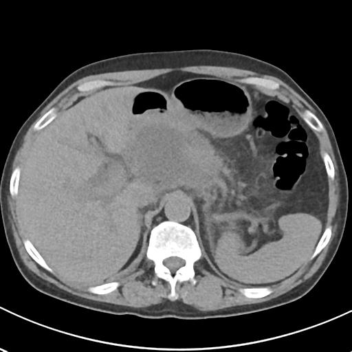 File:Acute pancreatitis and walled-off necrosis (Radiopaedia 29888-30404 Axial non-contrast 18).jpg