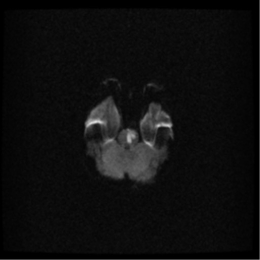 File:Acute pontine infarct from vertebral artery dissection (Radiopaedia 34111-35370 Axial DWI 7).png