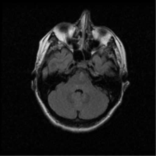 File:Acute pontine infarct from vertebral artery dissection (Radiopaedia 34111-35370 Axial FLAIR 5).png