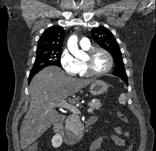 Acute pulmonary embolism with pulmonary infarcts (Radiopaedia 77688-89908 Coronal C+ CTPA 25).jpg