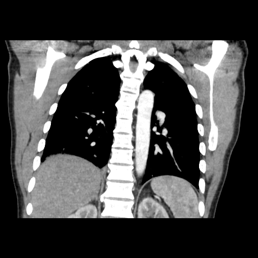 Acute segmental pulmonary emboli and pulmonary infarction (Radiopaedia 62264-70444 Coronal C+ CTPA 38).jpg