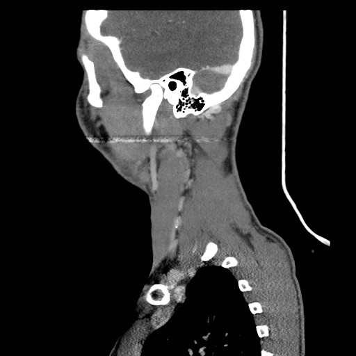 File:Acute submandibular sialadenitis secondary to ductal stone (Radiopaedia 27999-28267 Sagittal C+ delayed 5).jpg