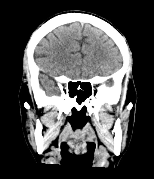 File:Acute superior cerebellar artery territory infarct (Radiopaedia 84104-99359 Coronal non-contrast 37).jpg