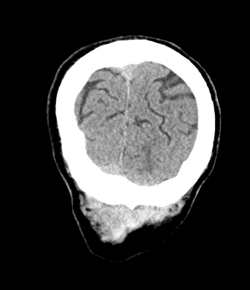 Acute superior cerebellar artery territory infarct (Radiopaedia 84104-99359 Coronal non-contrast 77).jpg