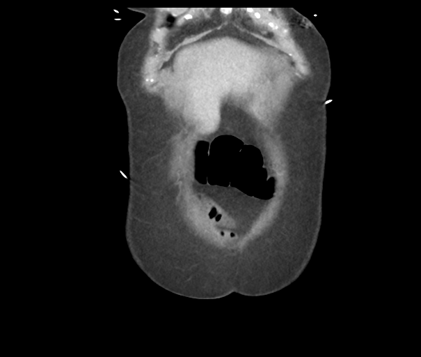 File:Acute superior mesenteric artery occlusion (Radiopaedia 43926-47418 Coronal C+ portal venous phase 8).png