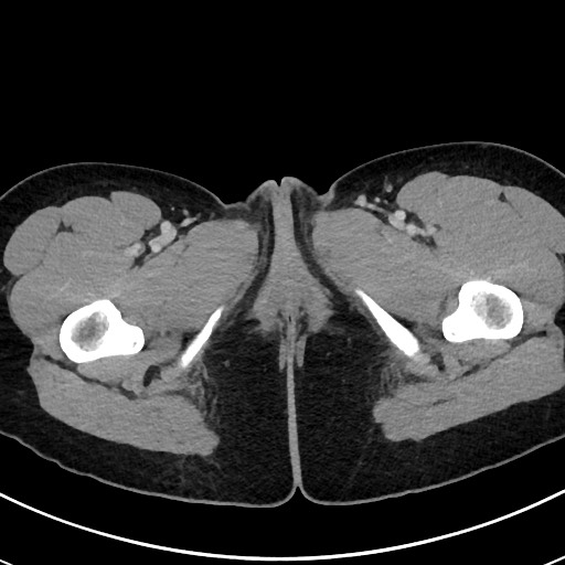File:Acute uncomplicated appendicitis (Radiopaedia 61374-69304 Axial C+ portal venous phase 145).jpg