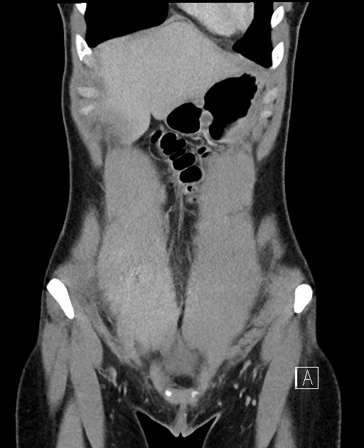 Acute uncomplicated appendicitis (Radiopaedia 61374-69304 Coronal C+ portal venous phase 21).jpg