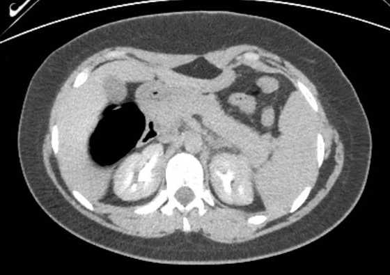 Acute unilateral nonhemorrhagic adrenal infarction (Radiopaedia 67560-76957 Axial renal excretory phase 39).jpg