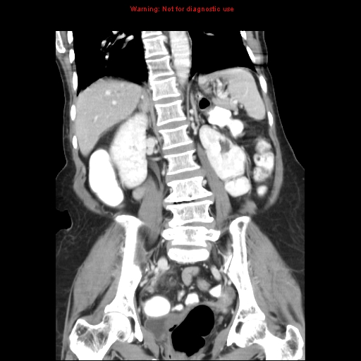 File:Adenocarcinoma of the colon (Radiopaedia 8191-9039 Coronal liver window 29).jpg