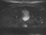 Adenocarcioma of rectum- T1 lesion (Radiopaedia 36921-38546 Axial DWI 46).png