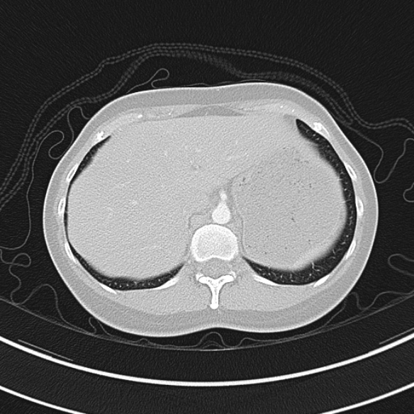 Adenocystic carcinoma of the trachea (Radiopaedia 47677-52525 Axial lung window 75).jpg