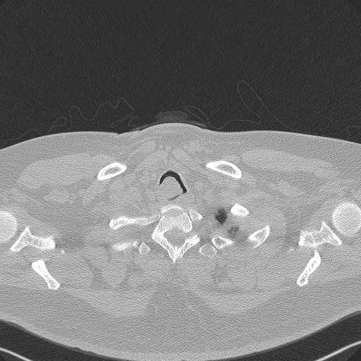 Adenoid cystic carcinoma of the trachea (Radiopaedia 49042-54137 Axial lung window 19).jpg